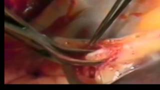 Arterial plaque prior to coronary artery bypass surgery - A must watch!