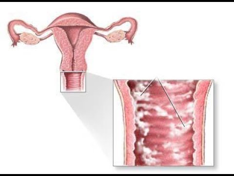 Che cosa. tumore alla prostata Come massaggiare le foto della prostata