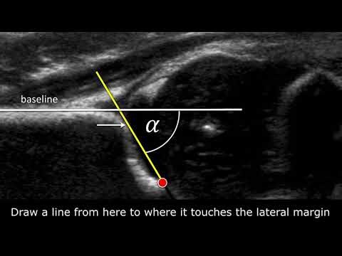 Congenital Hipdysplasia - How to measure angles