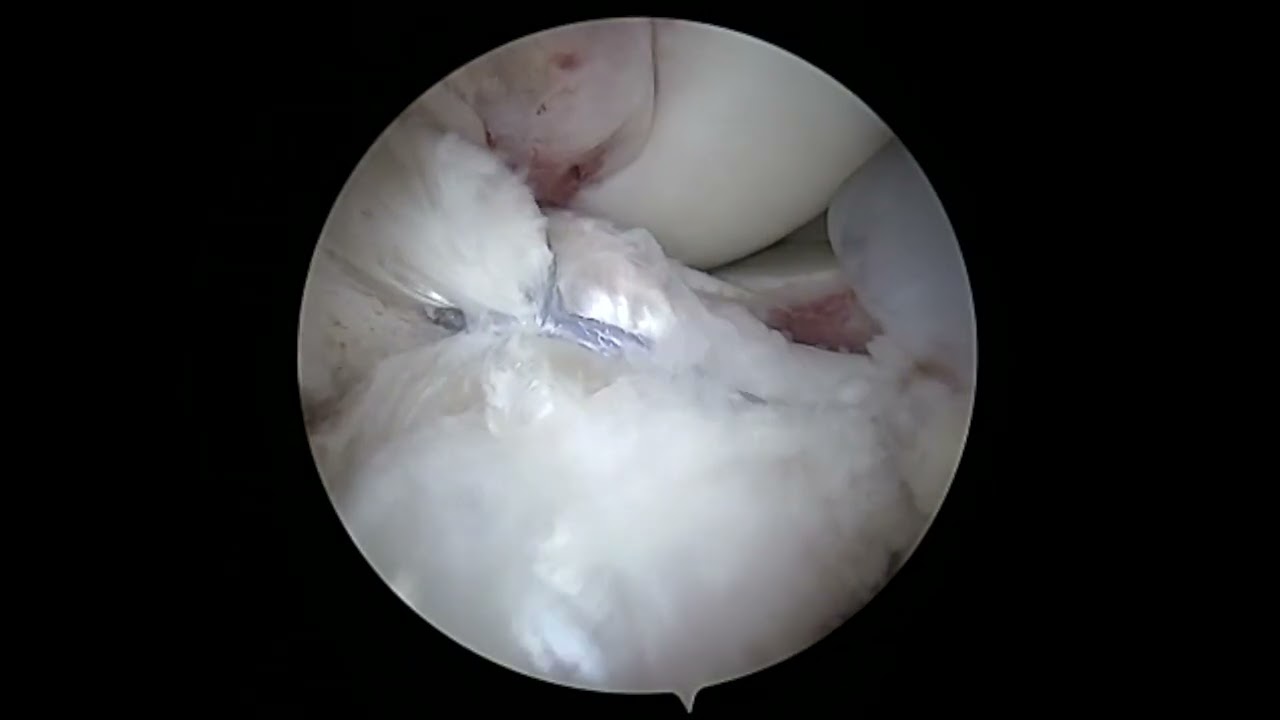 Dr. Garcia’s New Tensionable Tibial Spine Technique