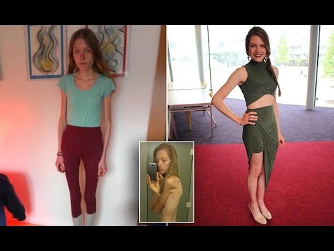 Anorexic student shares harrowing photos of skeletal physique to warn others about the disease