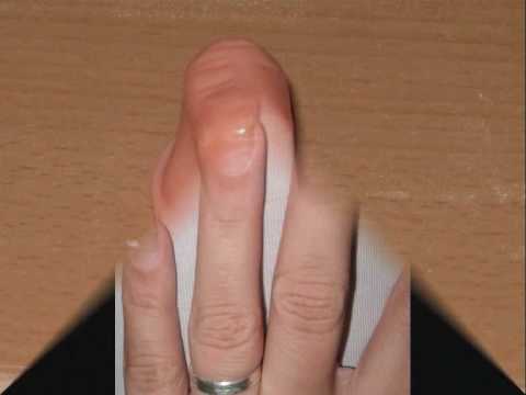 Tut den Daumen auf dem Bein unter dem Nagel die Behandlung weh Man kann gribok der Nägel von der Paste tejmurowa heilen