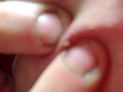 Dolore e bruciore al collo e le spalle Gel per il trattamento dellosteoartrosi del ginocchio
