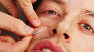 Acupuncture for Post-Stroke Recovery: A Practitioner Demonstrates Key Meridian Points