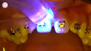 Braces bonding step by step in orthodontics &amp; wire insertion