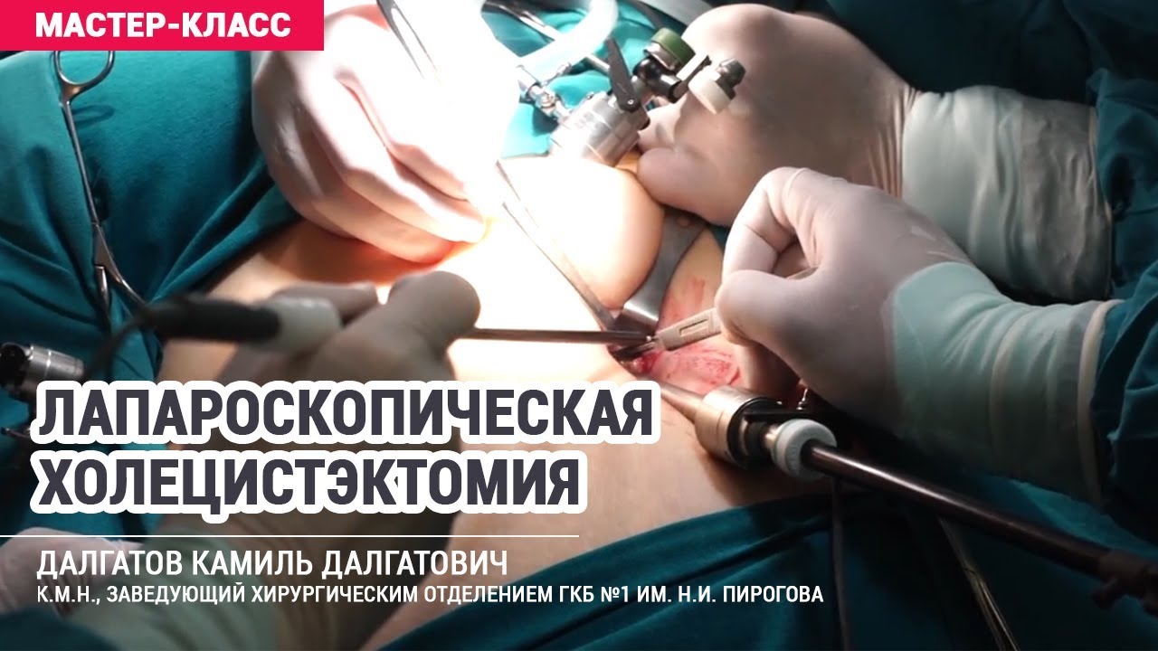 Лапароскопическая холецистэктомия