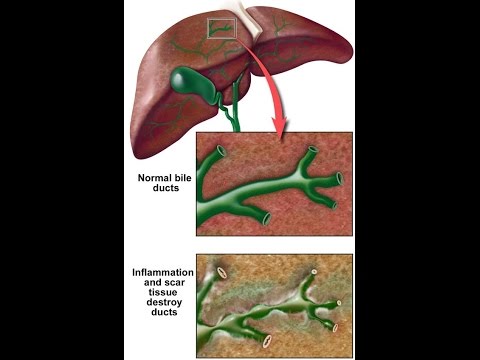 Primary Sclerosing Cholangitis