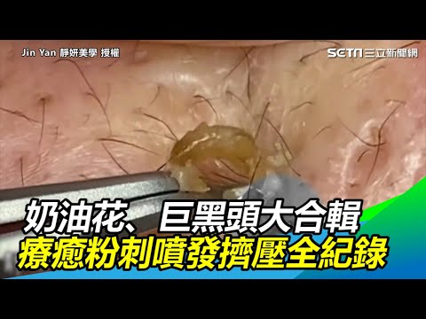 Face Cyst Pimple Blackheads Popping Compilations