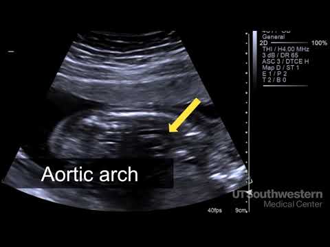 Understanding your fetal ultrasound