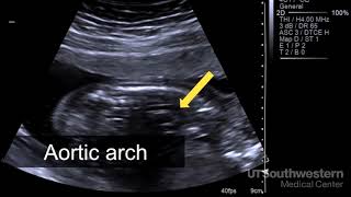 Understanding your fetal ultrasound