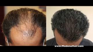 PRP Procedure with A Cell at Modena Hair Transplant Orange County
