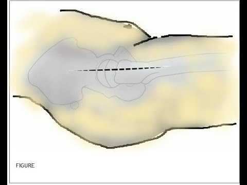 Hardinge Approach  ( Lateral Approach to the Hip )