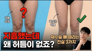 허벅지 지방흡입, 이걸 모르고 하면 또 망합니다😂