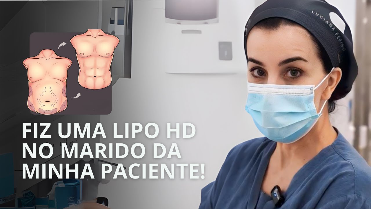 Lipo HD Masculina com Enxerto de Gordura no peito e deltoides