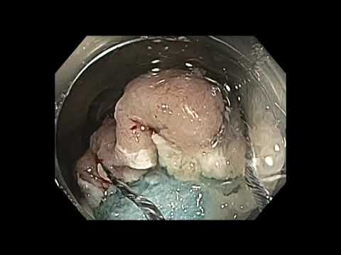 Colonoscopy: Rectum Large Polyp Resection