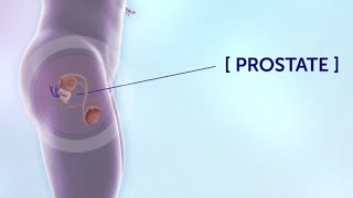 Prostate Cancer Treatment Support | Cancer Research UK