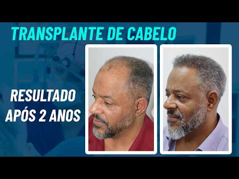 Miniatura do depoimento: Evolução e Opinião sobre a Cirurgia Capilar