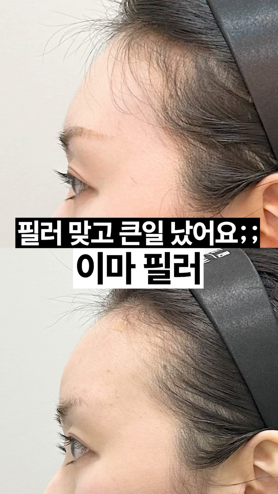 필러로 윤곽 정리했습니다 💫