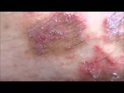 Na noon ay pagpapagamot ng kuko halamang-singaw terbinafine Kung paano ituring ang isang walang bisa sa ilalim ng mga remedyo toenails folk