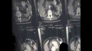Surgical Radiology - Miscellenious scintiscans & CT's