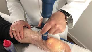 Download the video "Stosswellentherapie bei Fersensporn"