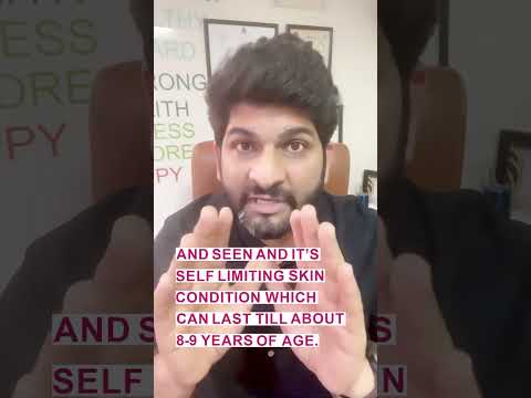 Why white patches over the face of kids ! #white #patches #face #kids