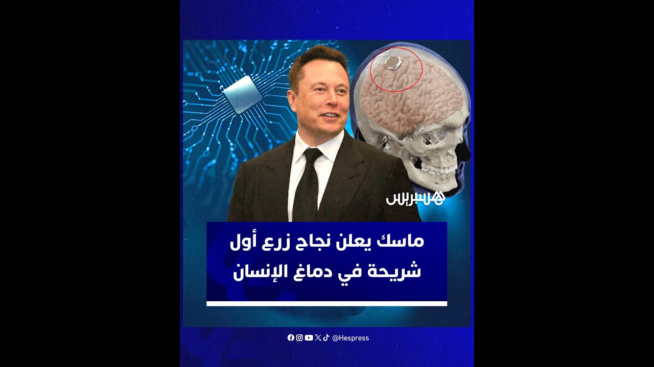 ماسك يعلن نجاح زرع أول شريحة في دماغ الإنسان thumbnail