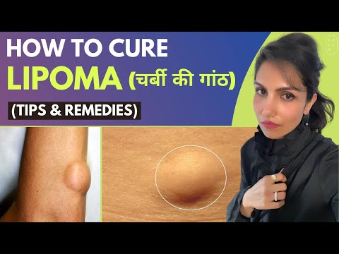 How To Cure Lipoma Naturally (चर्बी की गांठ)