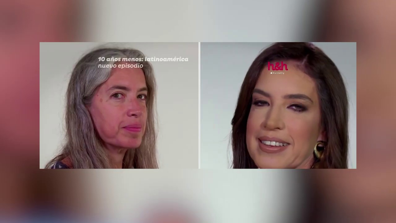 Transformaci&oacute;n est&eacute;tica de sonrisa en La Clinica Dental Lindavista CDMX, mostrando el antes y despu&eacute;s de un tratamiento dental.