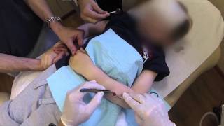 preview picture of video 'Child Mole Removal | Huntington, Long Island NY Lebowitz Plastic Surgery'
