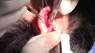 Otoplastia: operación orejas soplillo (otoplasty surgery)