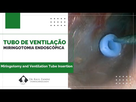 Miniatura: Timpanotomia para Tubo de Ventilação por Vídeo