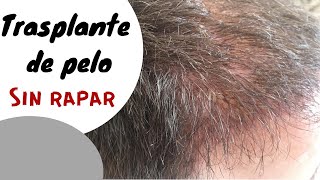 ¿Se puede hacer un trasplante de pelo sin rapar Injerto capilar sin rasurar