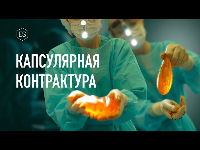 Капсулярная контрактура | ОСЛОЖНЕНИЯ после увеличения груди, маммопластика.