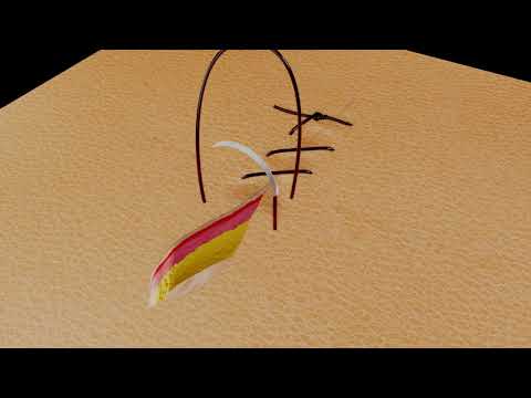 Suture Techniques - Running Simple Suture