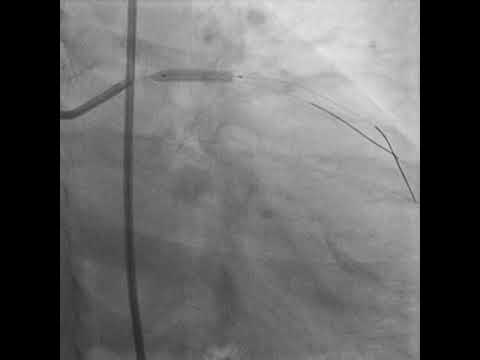 PROVISIONAL STENTING OF LAD - D1 BIFURCATION