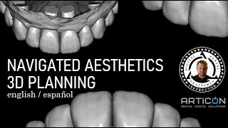 NAVIGATED AESTHETICS 3D PLANNING + EXOCAD SMILE CREATOR(webinar in english and spanish)