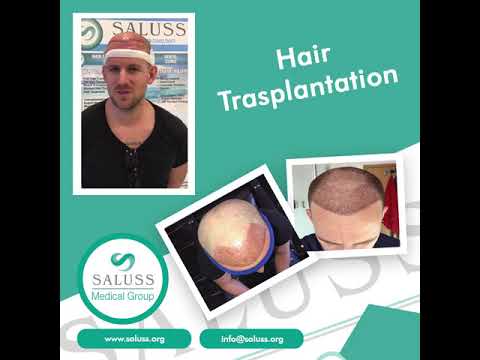 Successful Hair Transplant at Saluss Medical Group, Antalya, Turkey