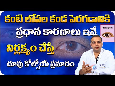 కంటి లోపల కండ || Pterygium Causes and Treatment in Telugu || Eye Care || True Vision Eye Hospital