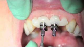 preview picture of video 'Customised impression bridge from Byrnes Dental and David Furze'