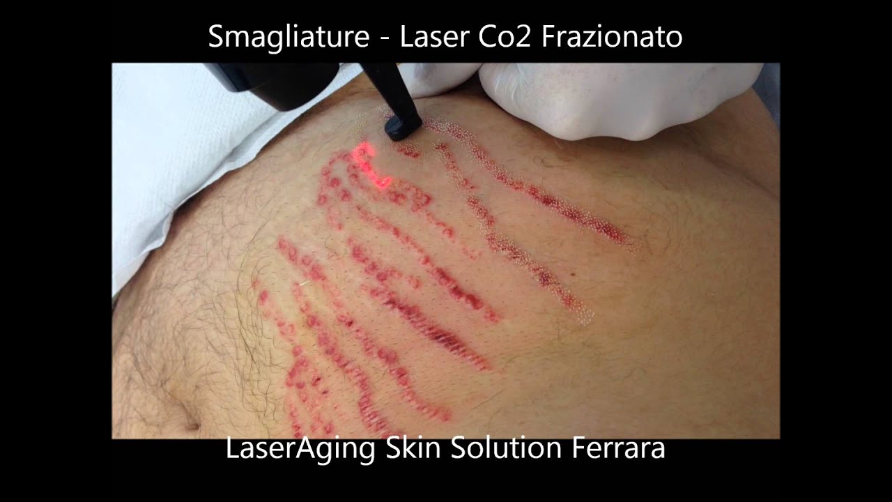 Smagliature Laser Qswitch + Laser Co2 frazionato Lutronic