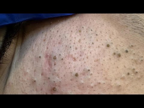Satisfying Pore Extraction ASMR — Big Whitehead & Blackhead Removal