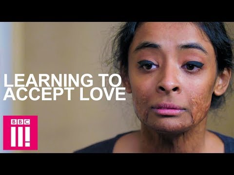 Burn Scars & Relationships: Accepting Love