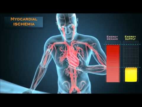 Understanding the energetic mechanisms that cause angina pectoris
