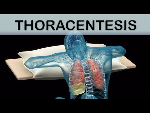 Thoracentesis Medical Animation