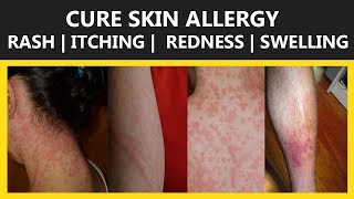 24 Home Remedies to Cure Skin Allergy  | Rash | Itching |  Redness | Swelling