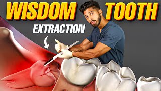 Wisdom Teeth Extraction (How to Flap, Section, and Extract Impacted Wisdom Teeth)