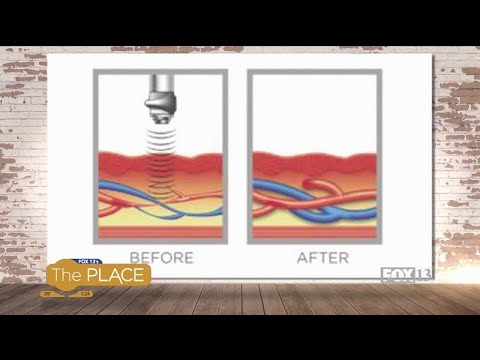 Acoustic Wave Therapy could fix your E.D.