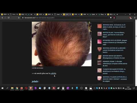 Vidéo : chute de cheveux — causes et traitements