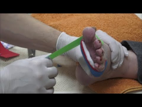 Podo Taping Concept© - Morton Neurom mit klinischen Tests